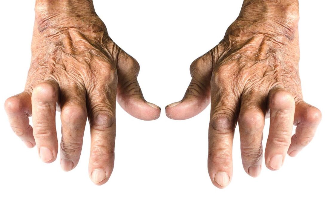 známky artritidy - deformace kloubu