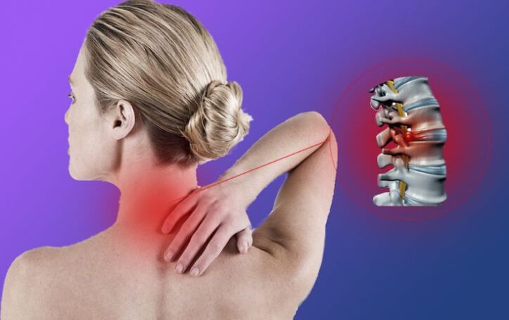 Osteochondróza krční páteře vede k rozvoji intervertebrálních kýl