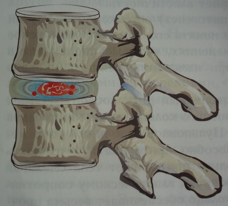 Poškození nucleus pulposus meziobratlové ploténky v první fázi cervikální osteochondrózy