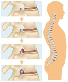 Čtyři fáze vývoje cervikální osteochondrózy