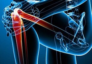 bolest kolene s artritidou a artrózou