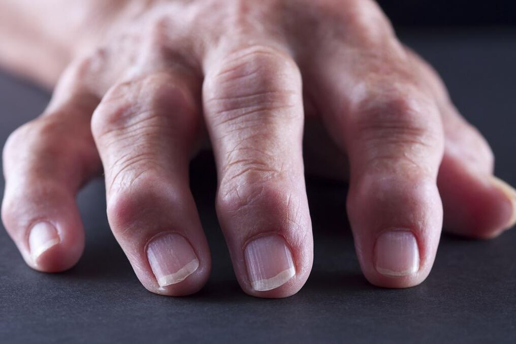 Bursitida je charakterizována bolestí, zánětem a otokem kloubů prstů