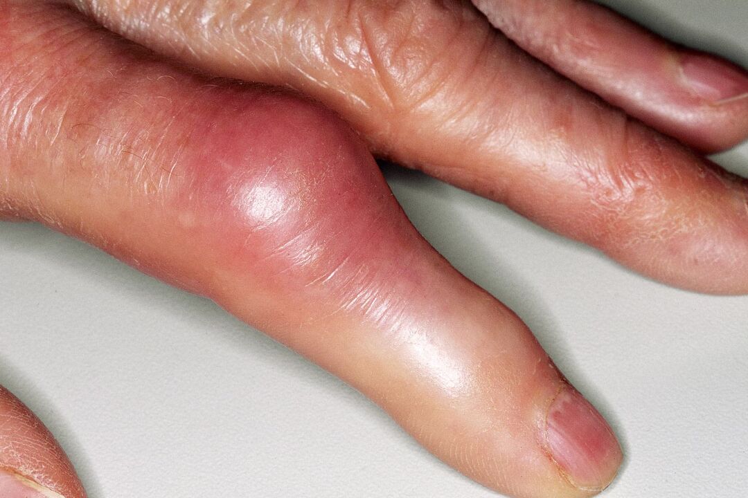 Otok, deformace článku prstu a akutní bolest po úrazu