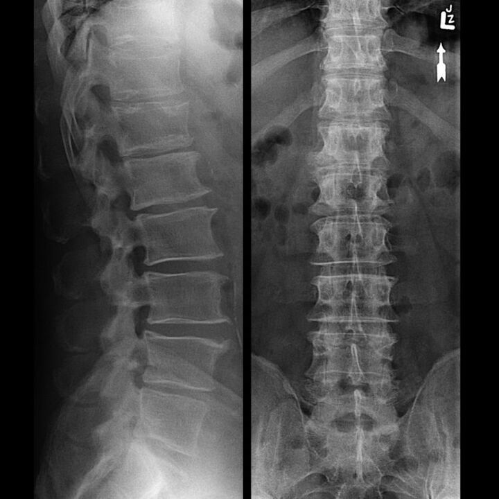 Scing páteře osteochondrosou