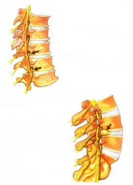 ilustrace spinální osteochondrózy
